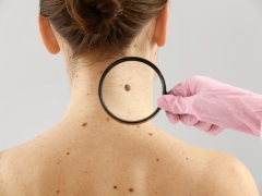 Precisan diagnósticos de cáncer de piel de tipo melanoma con Inteligencia Artificial