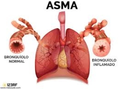 Noticia: Expertos alertan por alta prevalencia y subdiagnóstico de asma en Chile